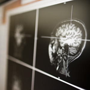Vaccine strategy for Parkinson’s disease